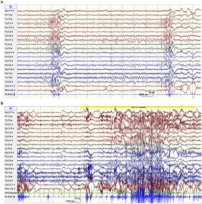 Case Report: Distinctive EEG Patterns in SCARB-2 Related Progressive Myoclonus Epilepsy